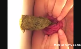Anal prolapse after pooping